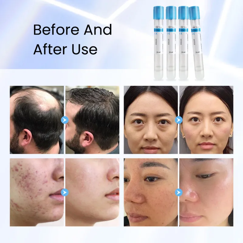 PRP Therapy – Platelet-Rich Plasma Treatment
