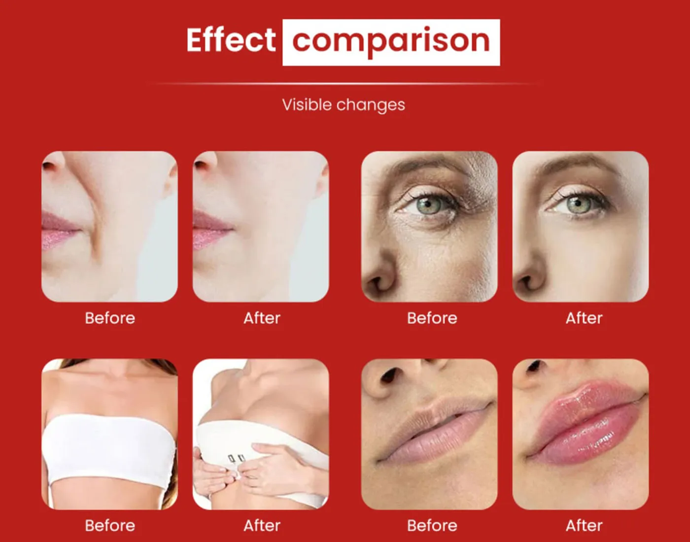 Volume Restoration – Dermal Filler Injection