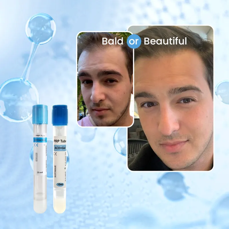 PRP Therapy – Platelet-Rich Plasma Treatment